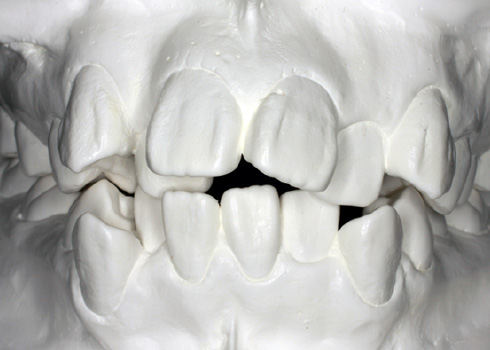 歯列の模型