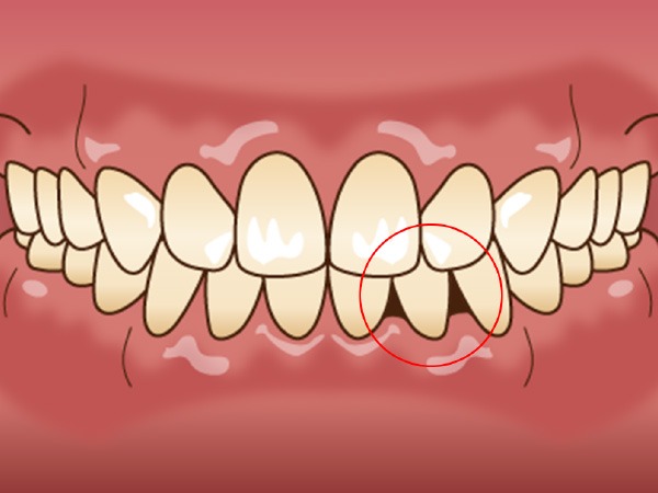 歯肉(歯ぐき)の退縮