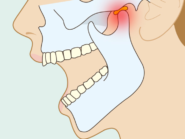 あごの関節の痛み