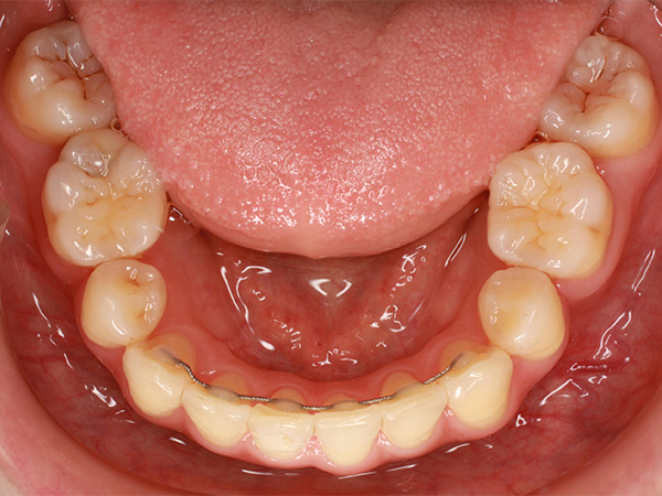歯根(歯の根っこ)の吸収